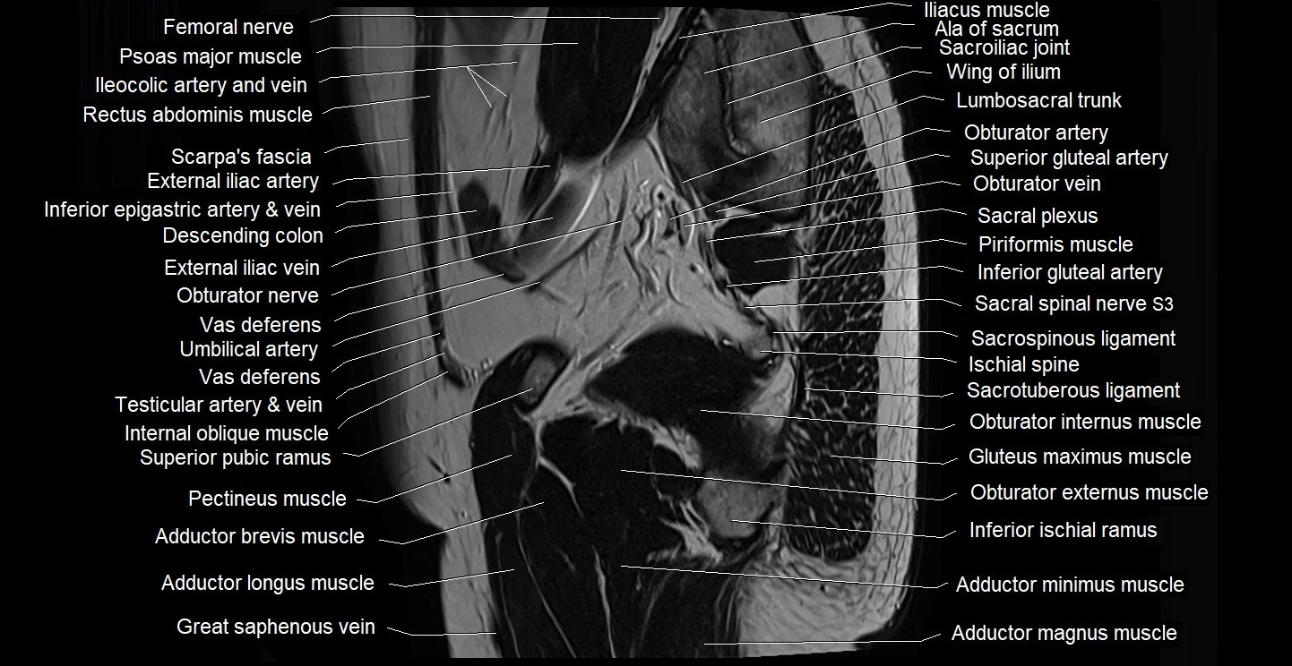 male pelvis sagittal cross sectional anatomy 3T mri image 10.webp